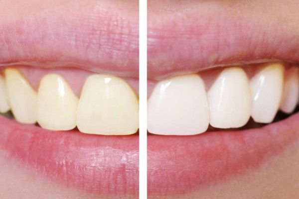 Λευκά δόντια: Έτσι θα τα αποκτήσετε - Απλώστε μαγειρική σόδα στην οδοντόβουρτσά σας και βουρτσίστε καλά