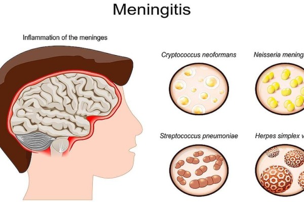 Μηνιγγίτιδα: Πόσα είδη υπάρχουν; Ποια μπορούν να οδηγήσουν στον θάνατο; Προβληματισμός με τον ξαφνικό χαμό 20χρονου φοιτητή στην Πάτρα