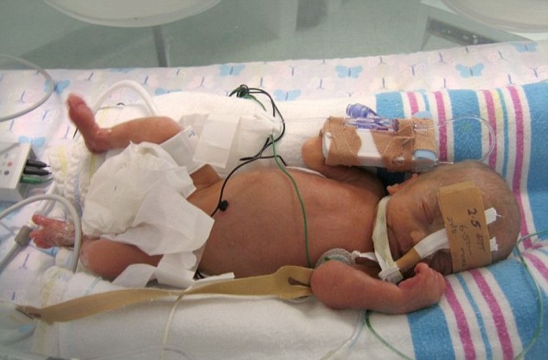 Νεογέννητο μωράκι στην θερμοκοιτίδα